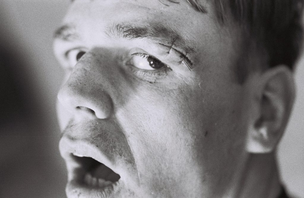 Black-and-white close-up photograph of a resident's face showing stitches above one eyebrow while looking upward with mouth partially open.